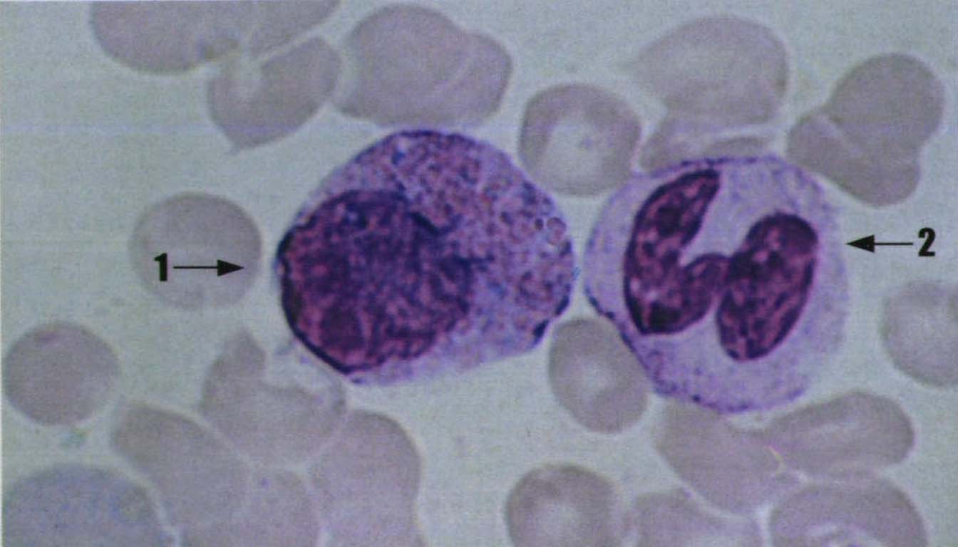 图27 嗜酸性中幼粒细胞